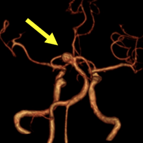 脳動脈瘤（頭部MRA）