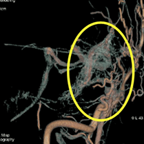 脳血管撮影（3D画像）