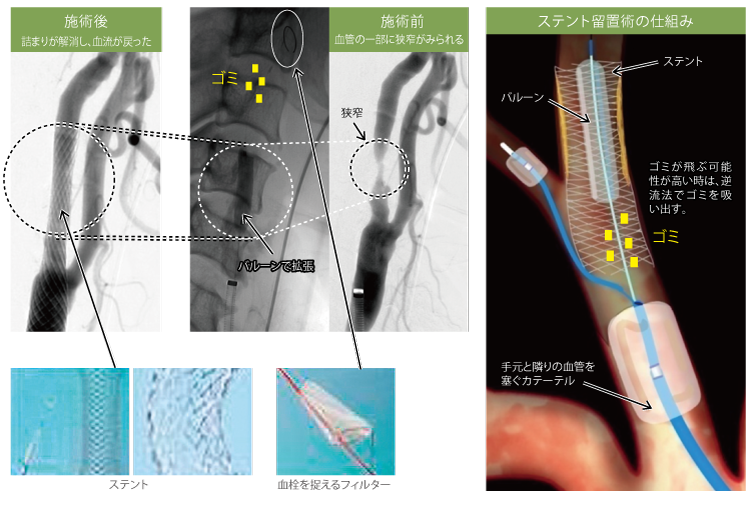 ステントの種類